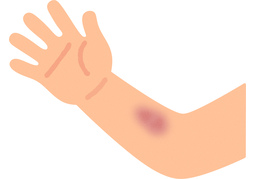 bruiseのイラスト