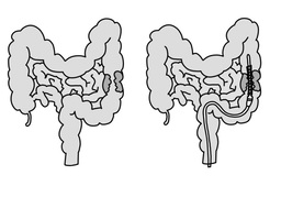 cancerのイラスト