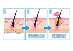 incidenceのイラスト
